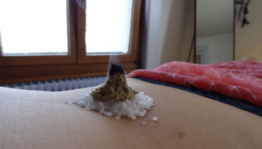 Acupuncture